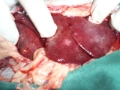 Hepatitis Inflamatoria Crónica