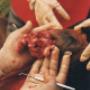 hemangioma perineal