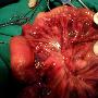 torsion intestinal