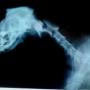 trauma craneal frontolateral derecho