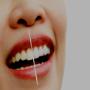 Blanqueamiento dental