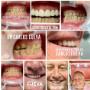 Coronas de zirconio