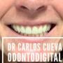 Coronas de zirconio