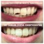 Fractura en dientes anteriores