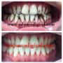 Limpieza dental profunda o destartraje