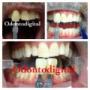 BLANQUEAMIENTO DENTAL