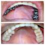 Rehabilitacion oral superior