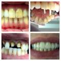 CORONAS DE ZIRCONIO