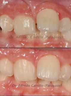Frenillo-Labial-Superior
