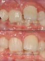 Frenillo labial Superior ¿Cuándo Intervenir