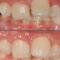 Frenillo-Labial-Superior