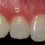 C-Alzam-Diastema-Antes-1