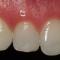 C-Alzam-Diastema-Antes-1