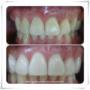 Blanqueamiento Dental