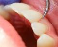 Profilaxis Dental