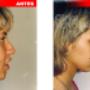 Rinoplastia Lima Peru