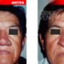 Rinoplastia Lima Rinofima