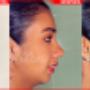 Rinoplastia Lima