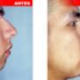 rinoplastia mentoplastia Lima