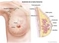 TRATAMIENTO ESPECIALIZADO DEL CÁNCER AL SENO