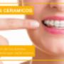 Brackets ceramicos