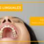 Brackets linguales