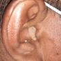 Audifono Medicado Invisible