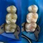 Restauraciones dentales