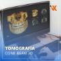 Tomografías