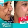 Tratamiento de melasma